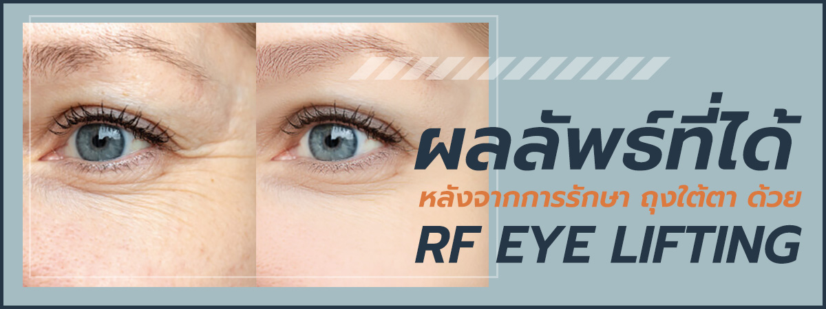 วิธีรักษาถุงใต้ตาด้วย RF Eye Lifting