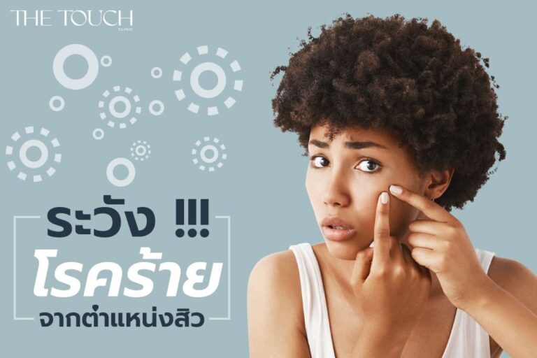 สิวบ่งบอกโรค สัญญาณเตือน สิวขึ้นหน้า บอกโรคร้าย!