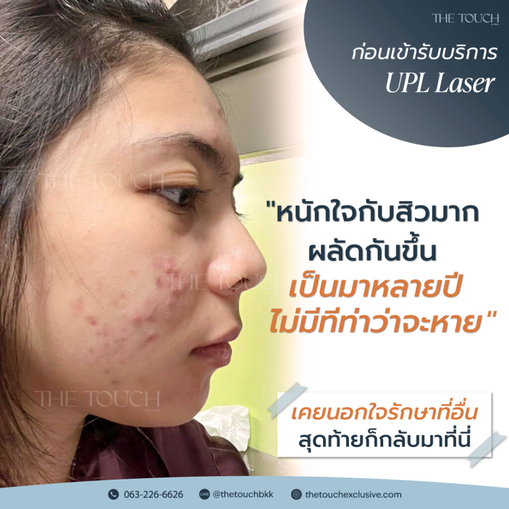 review-upl-ultimate-intensive-pulse-light
