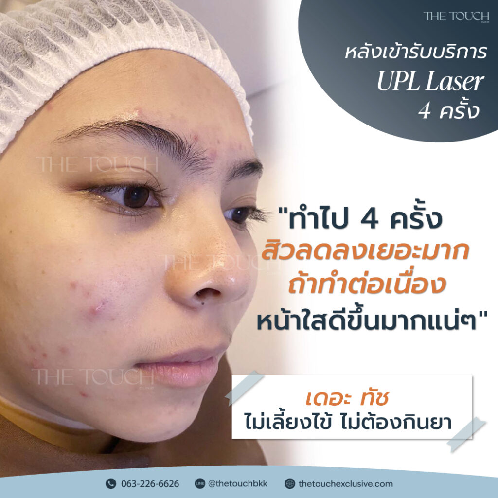 review-upl-ultimate-intensive-pulse-light
