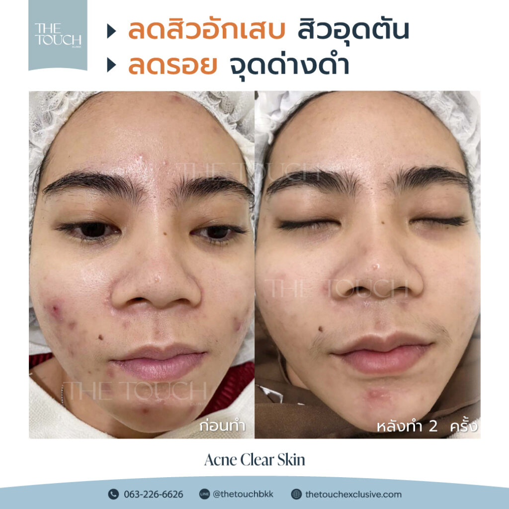 review-acne-clear-skin