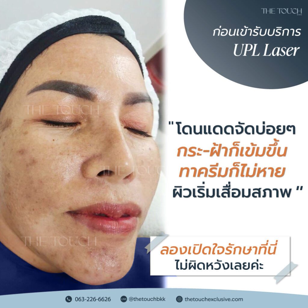 review-upl-ultimate-intensive-pulse-light