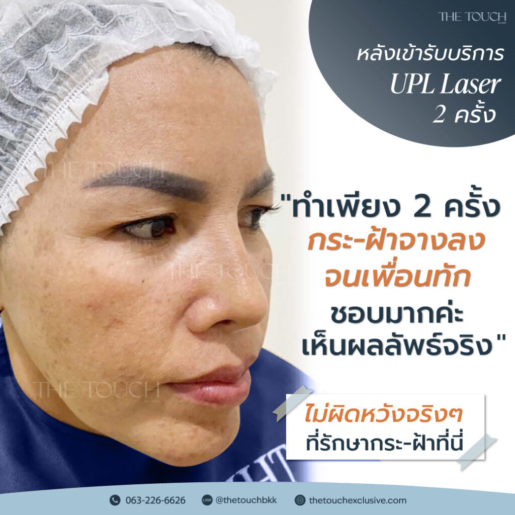 review-upl-ultimate-intensive-pulse-light