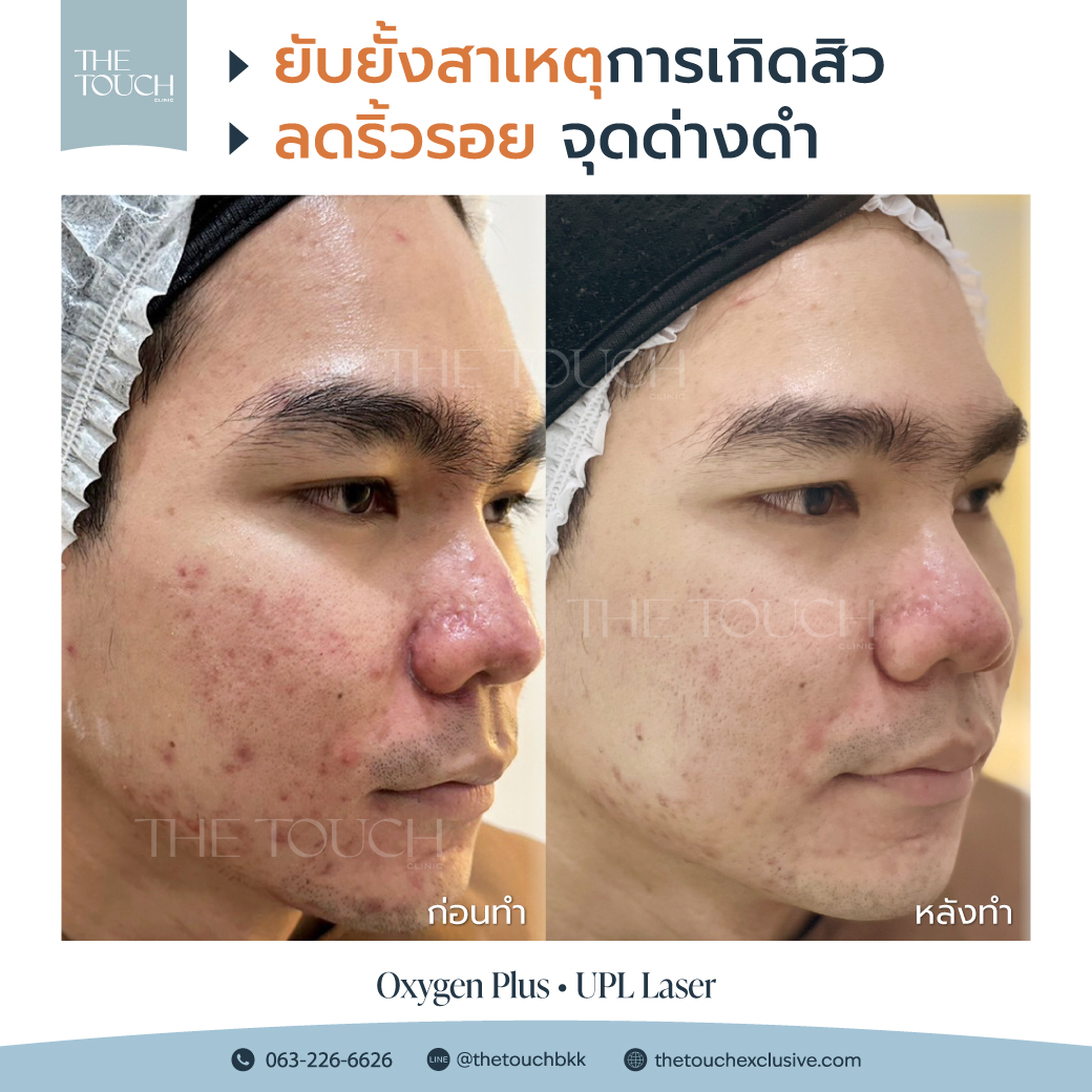 review-upl-ultimate-intensive-pulse-light