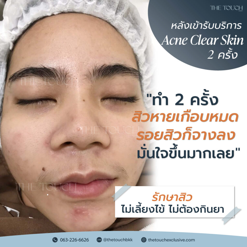 review-acne-clear-skin