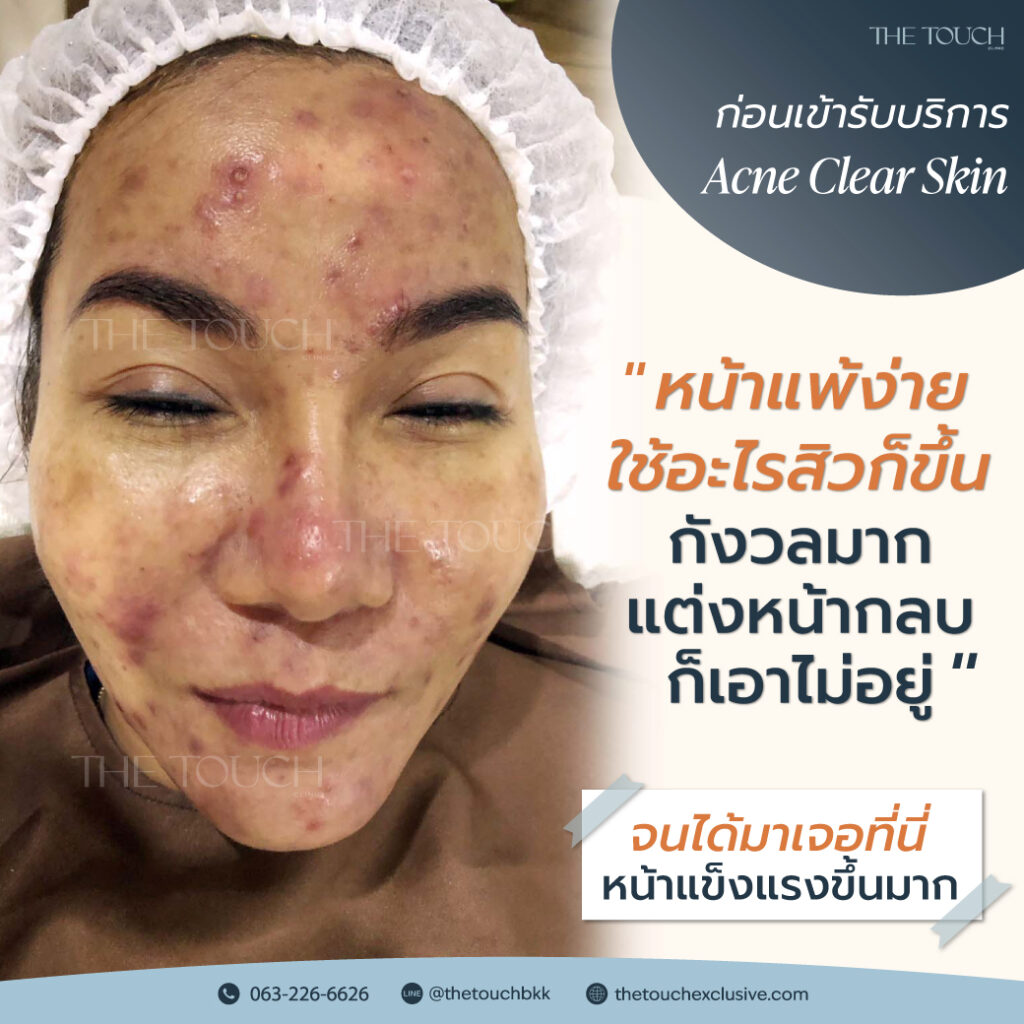 review-acne-clear-skin