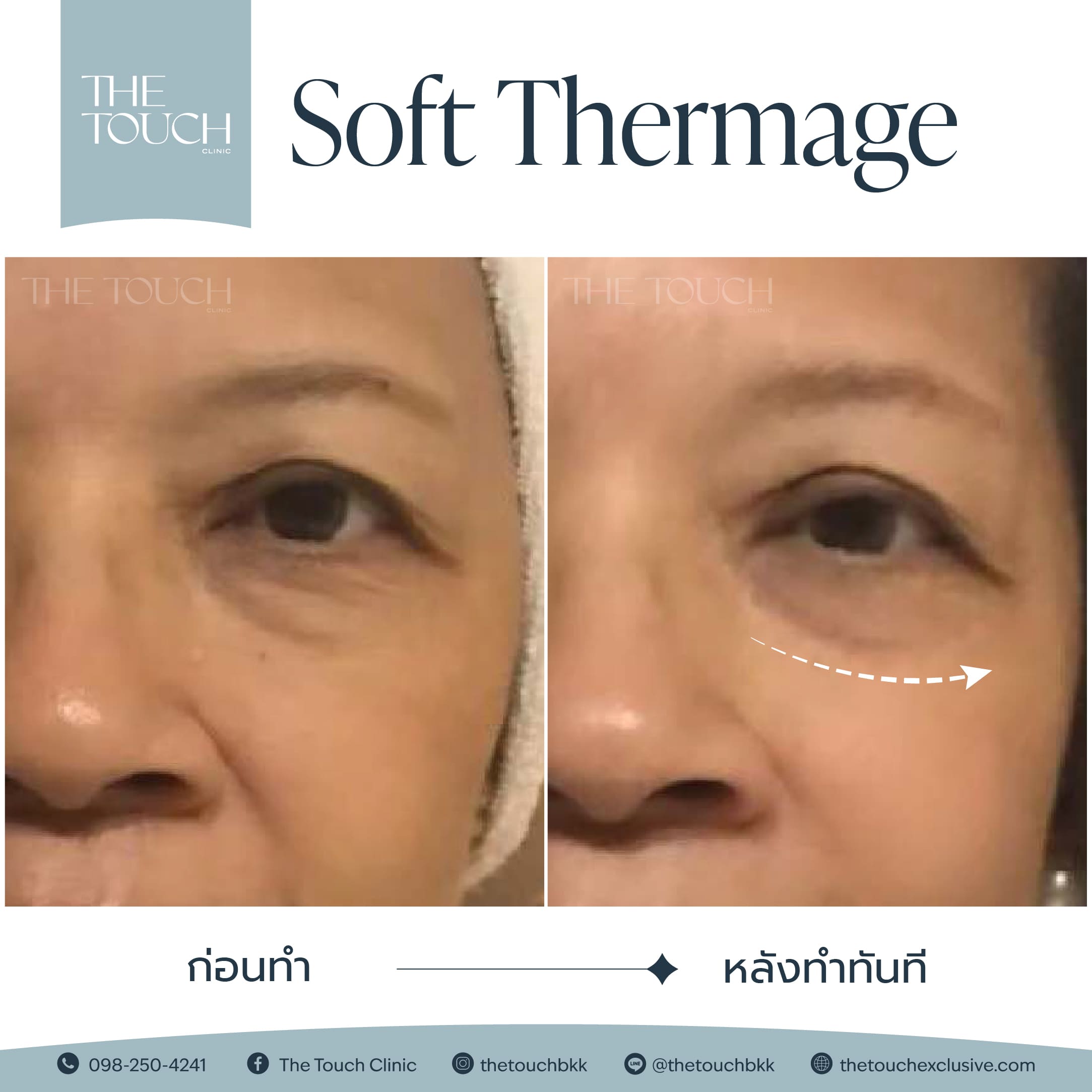 review-soft-thermage