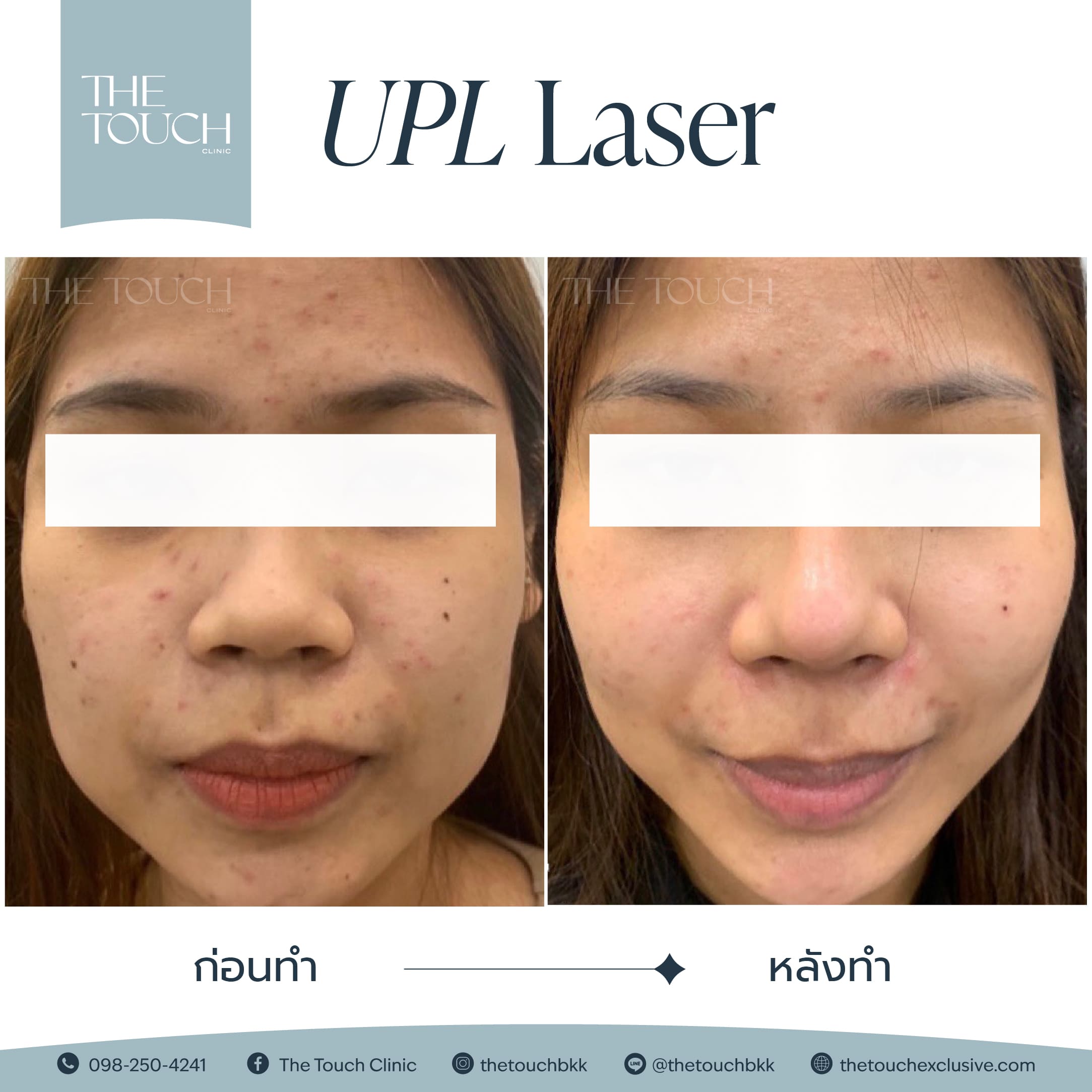 review-upl-ultimate-intensive-pulse-light
