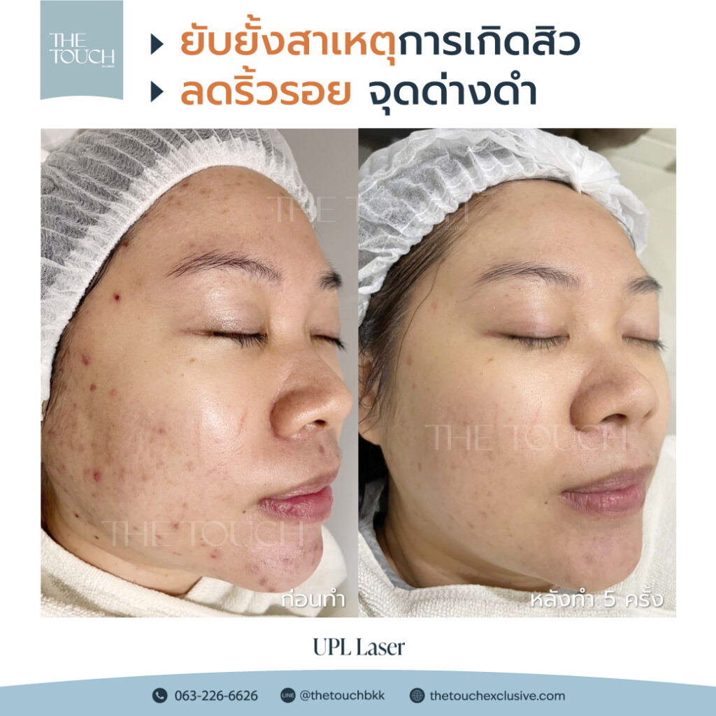 review-upl-ultimate-intensive-pulse-light