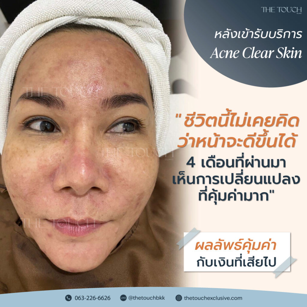 review-acne-clear-skin