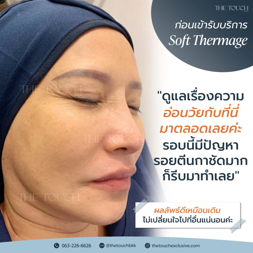 review-soft-thermage