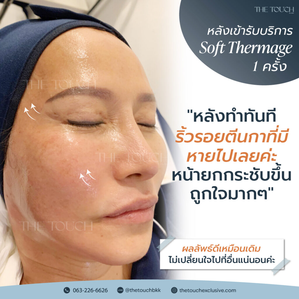 review-soft-thermage