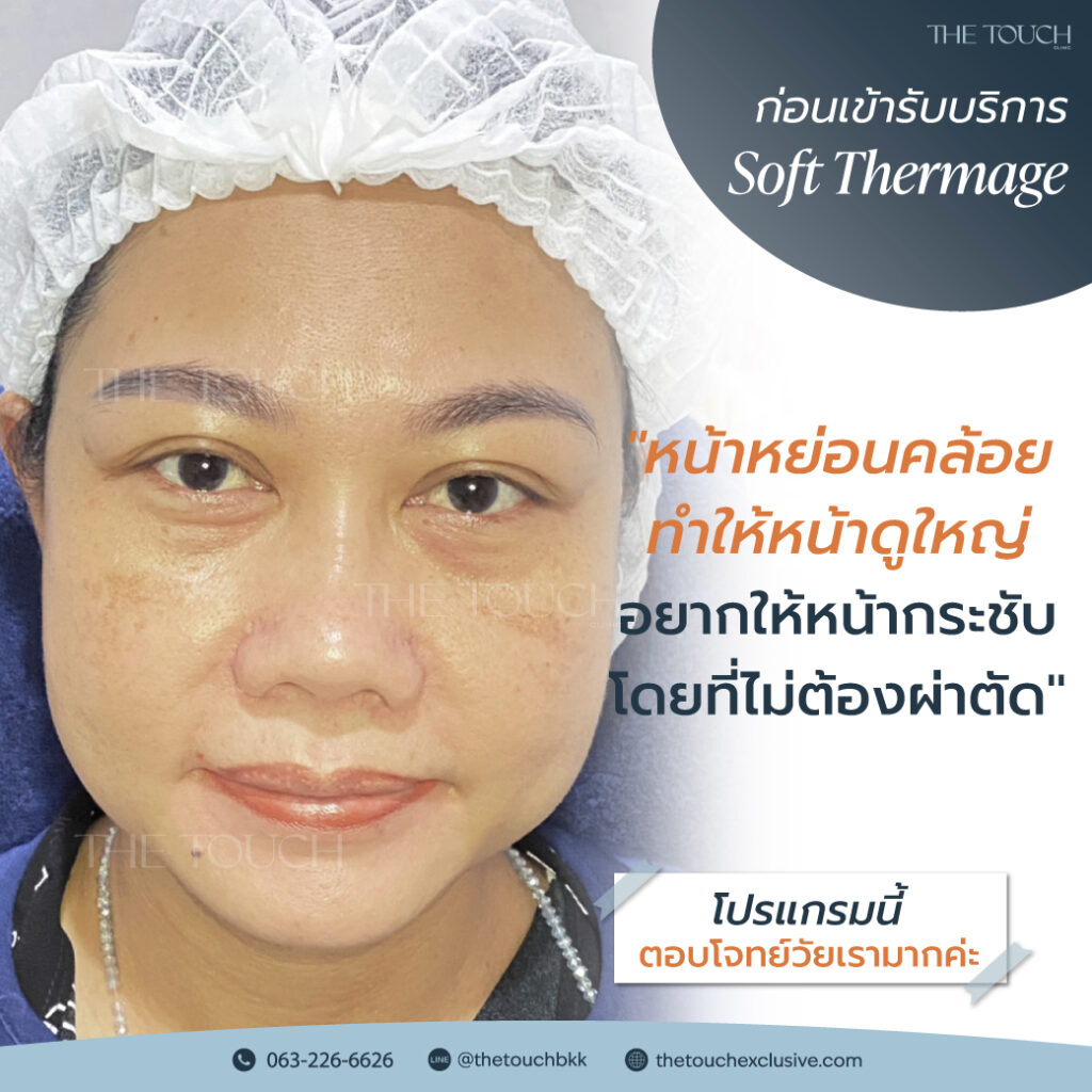 review-soft-thermage