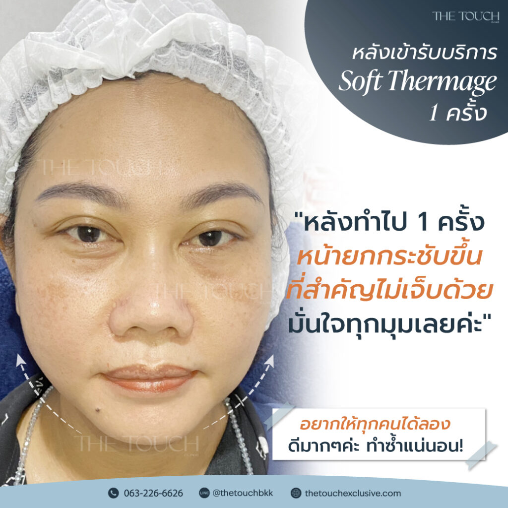 review-soft-thermage