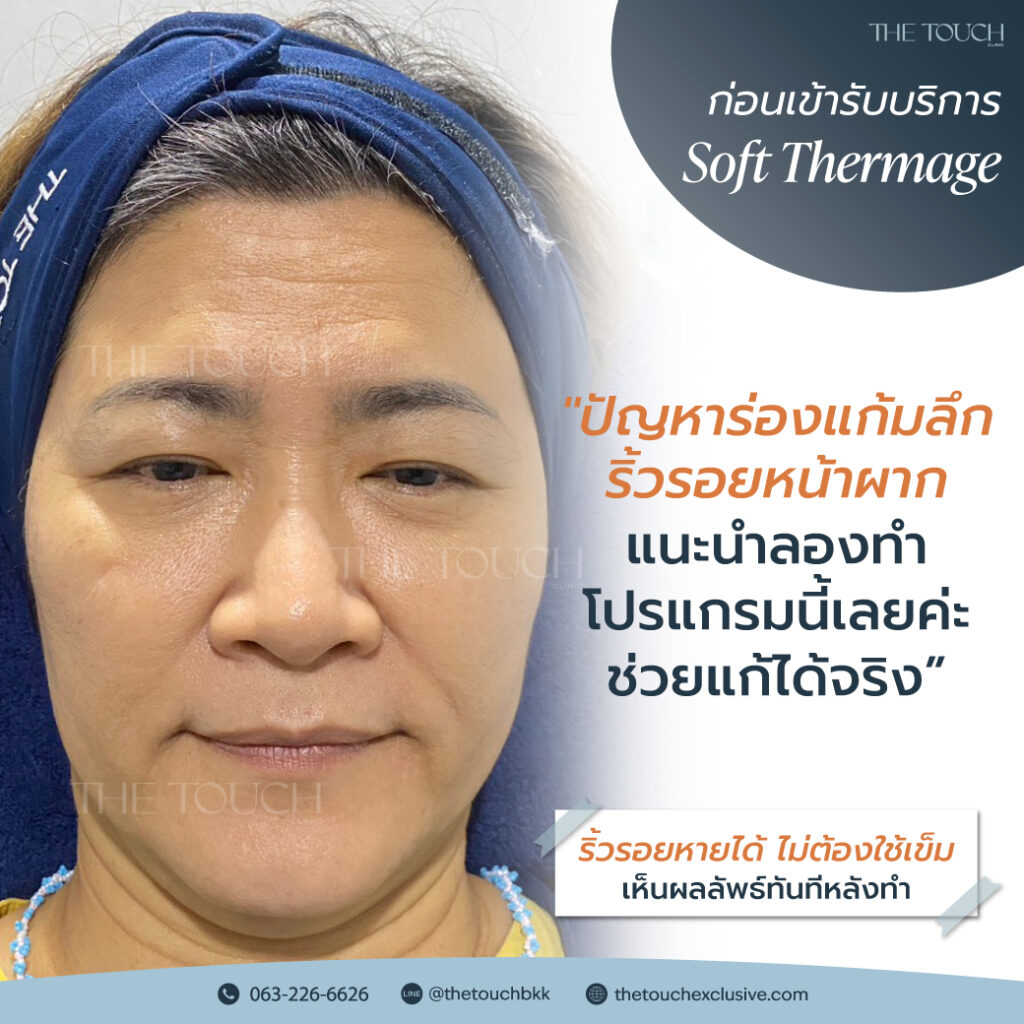 review-soft-thermage