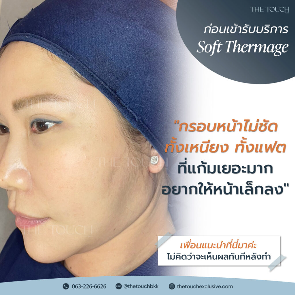 review-soft-thermage