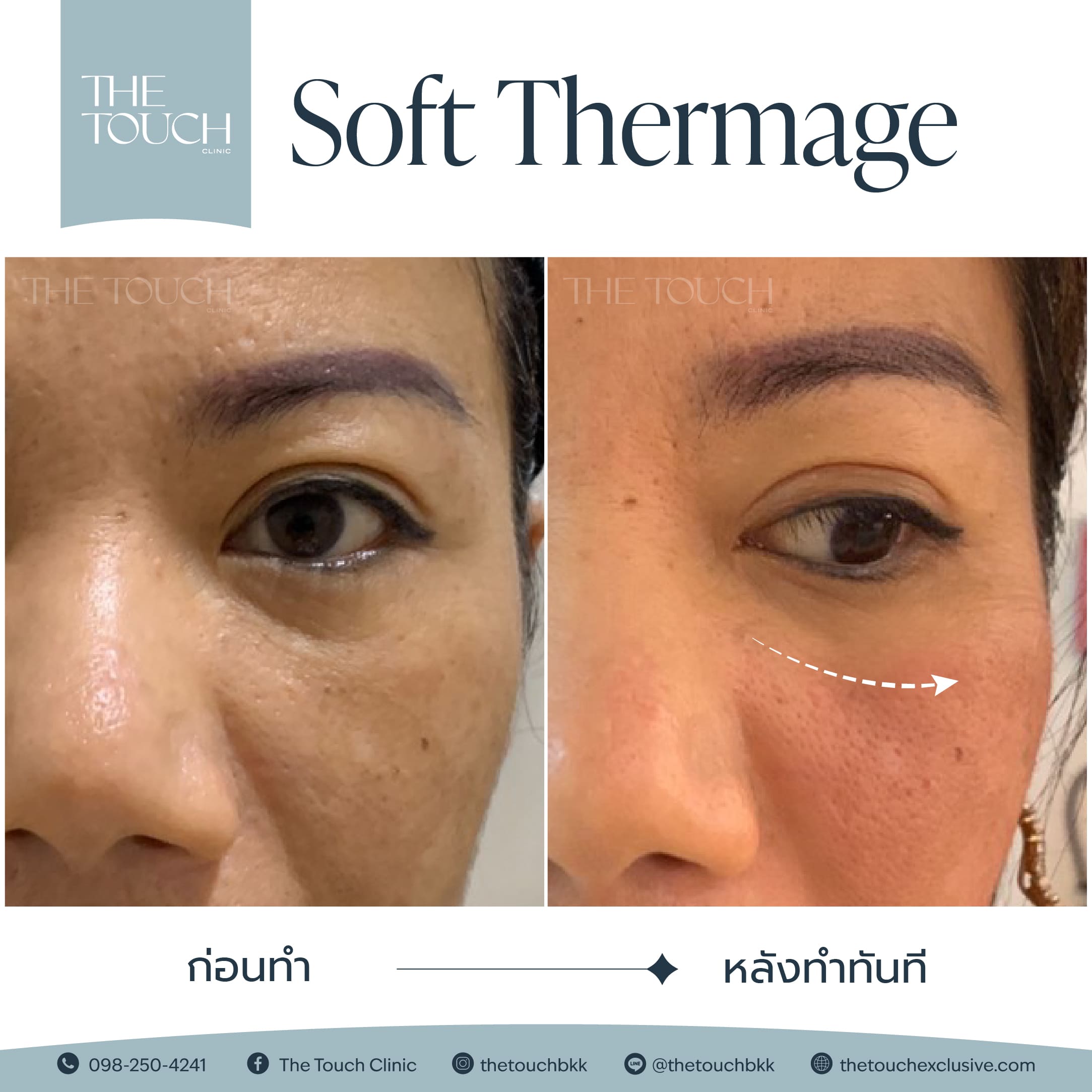 review-soft-thermage