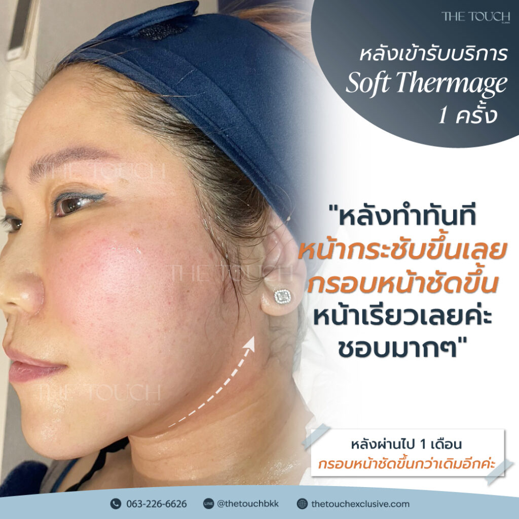 review-soft-thermage