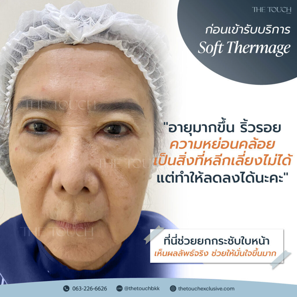 review-soft-thermage