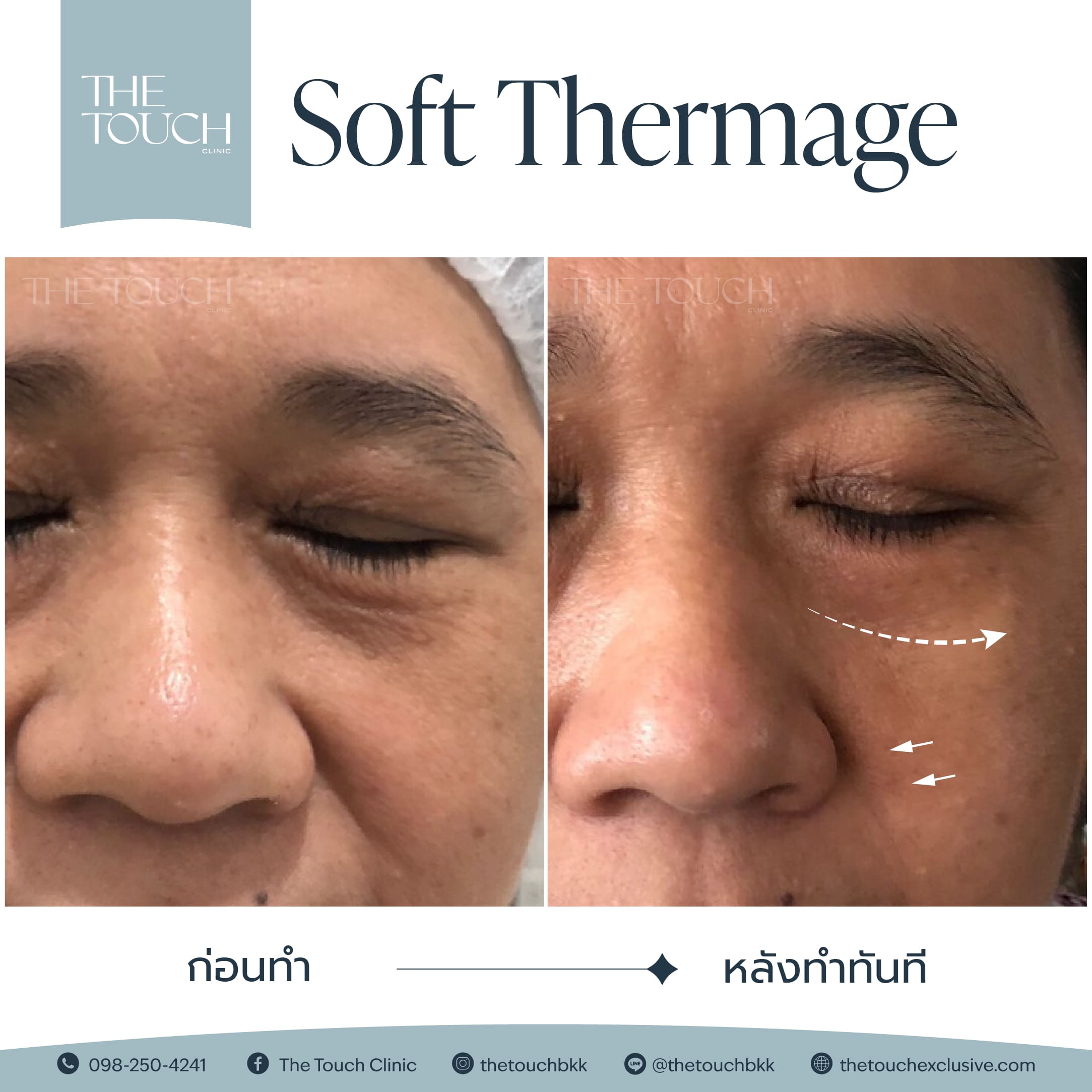 review-soft-thermage