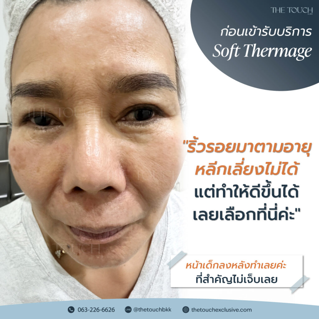review-soft-thermage