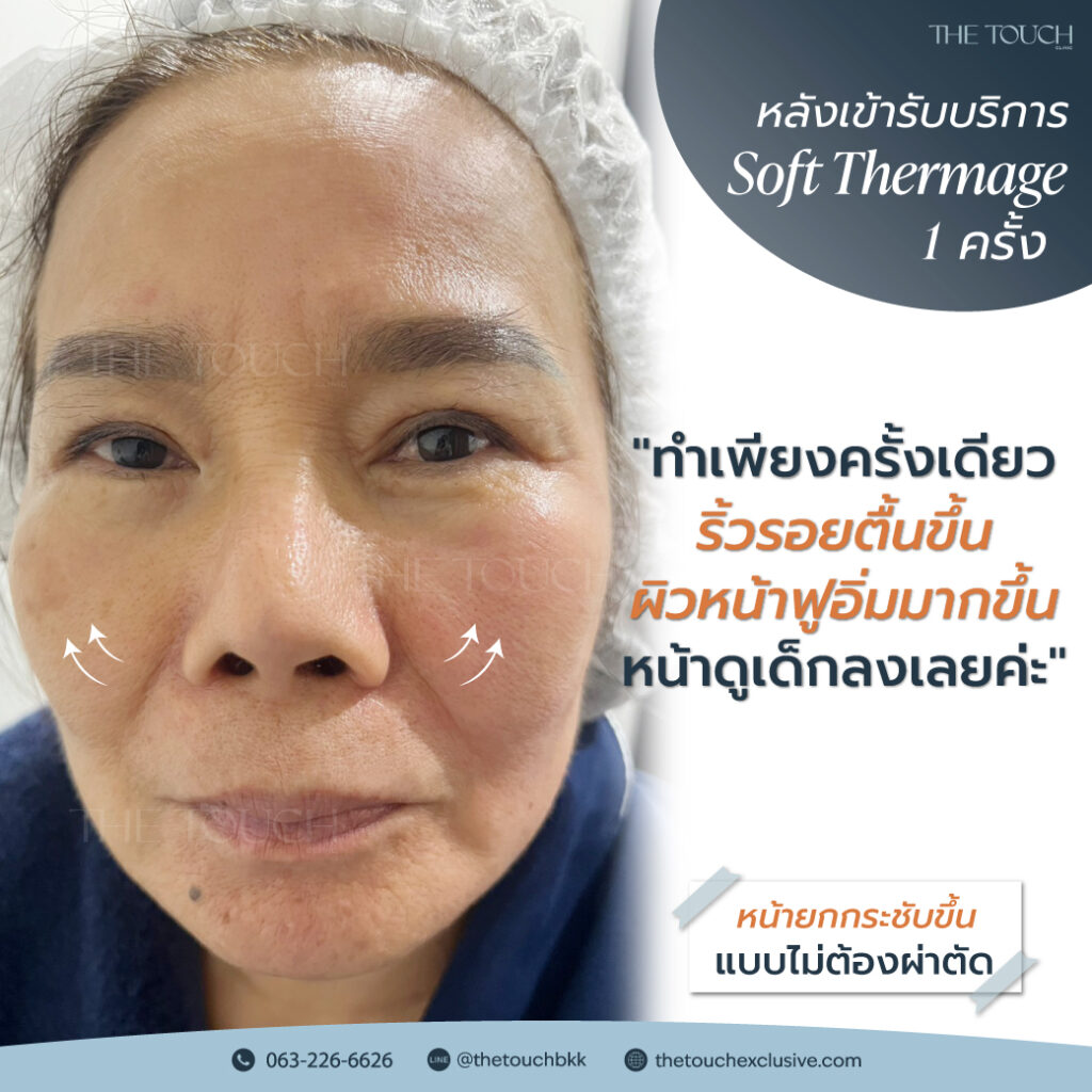 review-soft-thermage