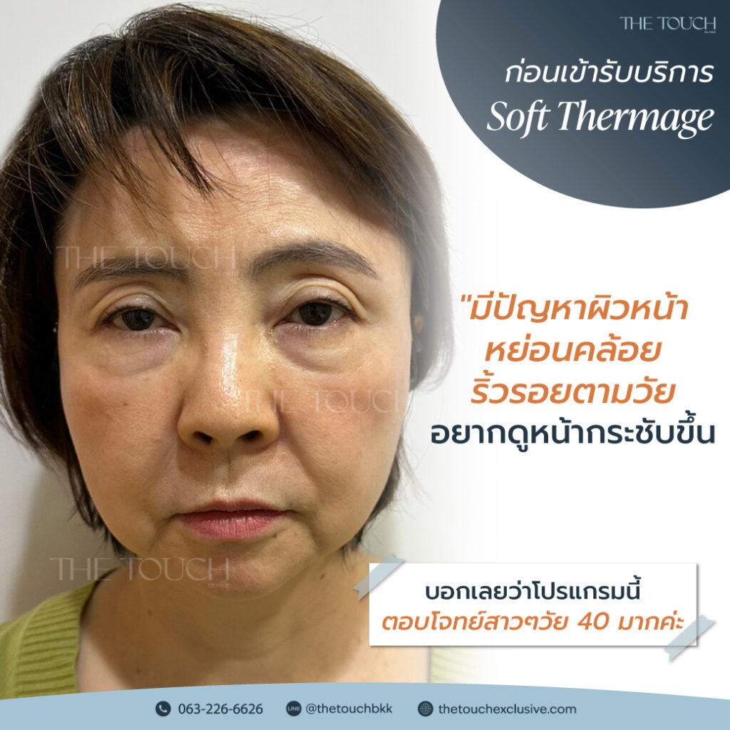 review-soft-thermage