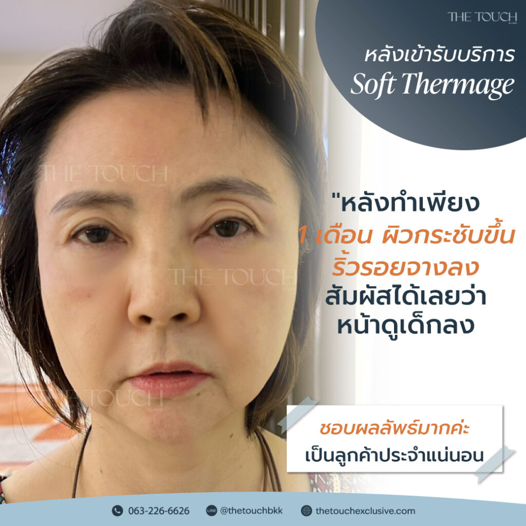 review-soft-thermage