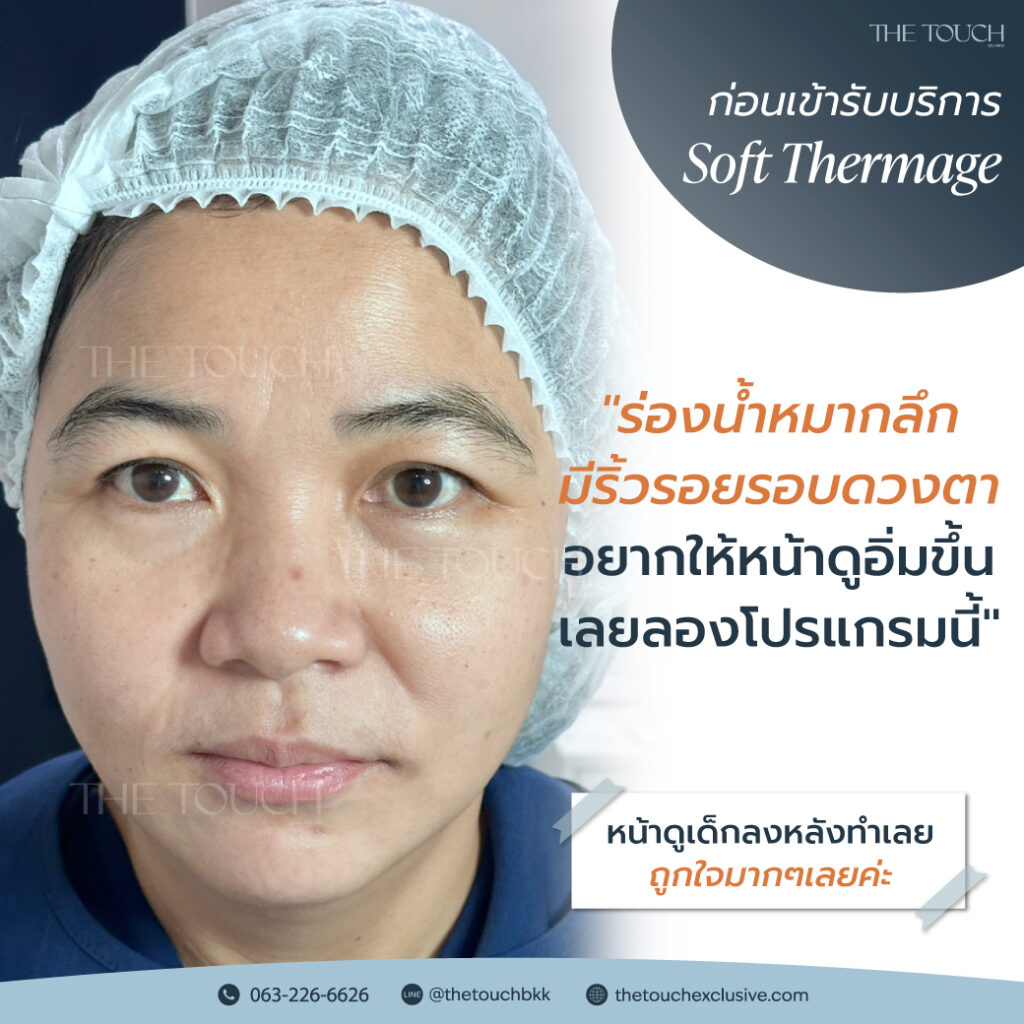 review-soft-thermage