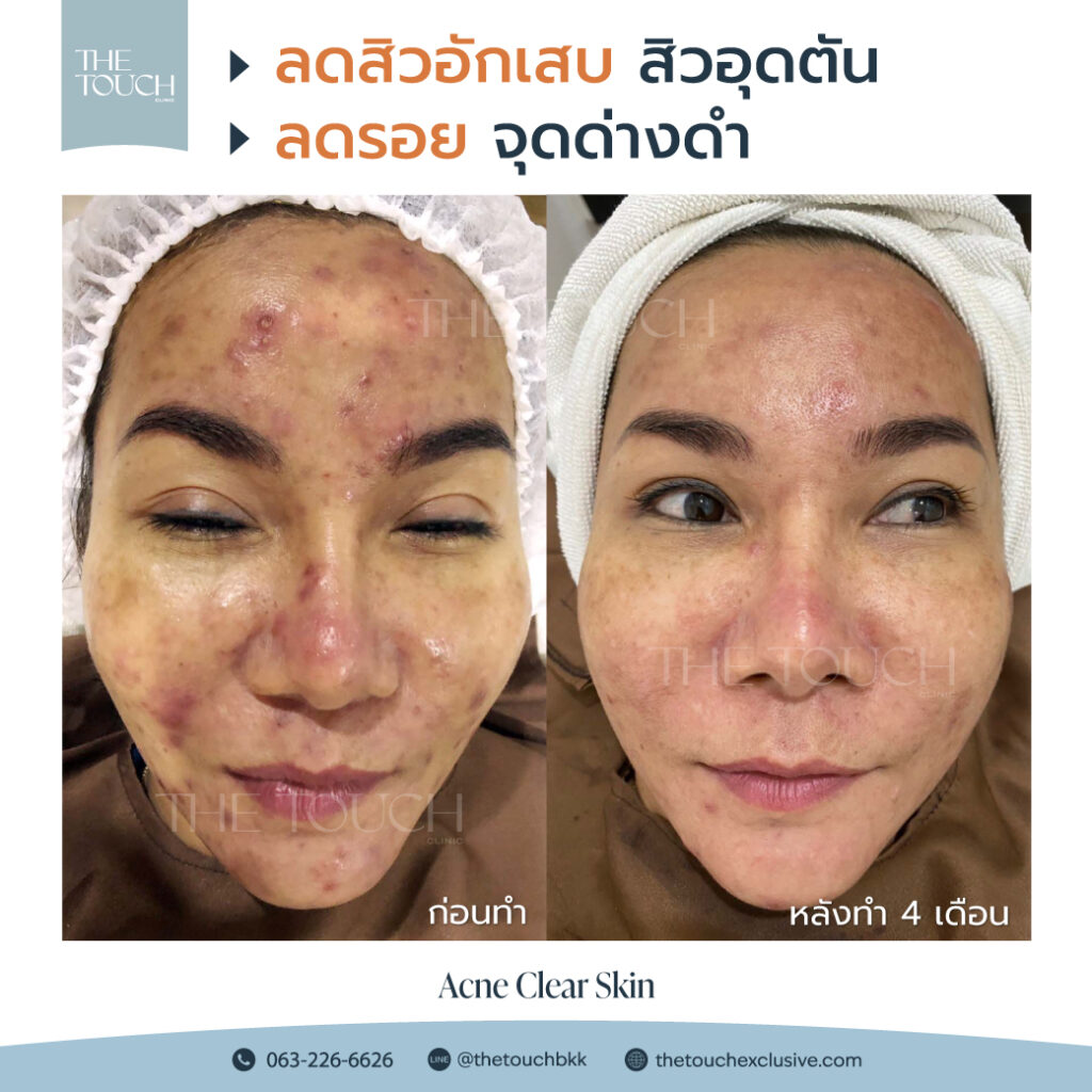 review-acne-clear-skin