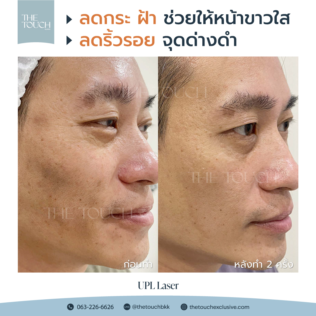 review-upl-ultimate-intensive-pulse-light