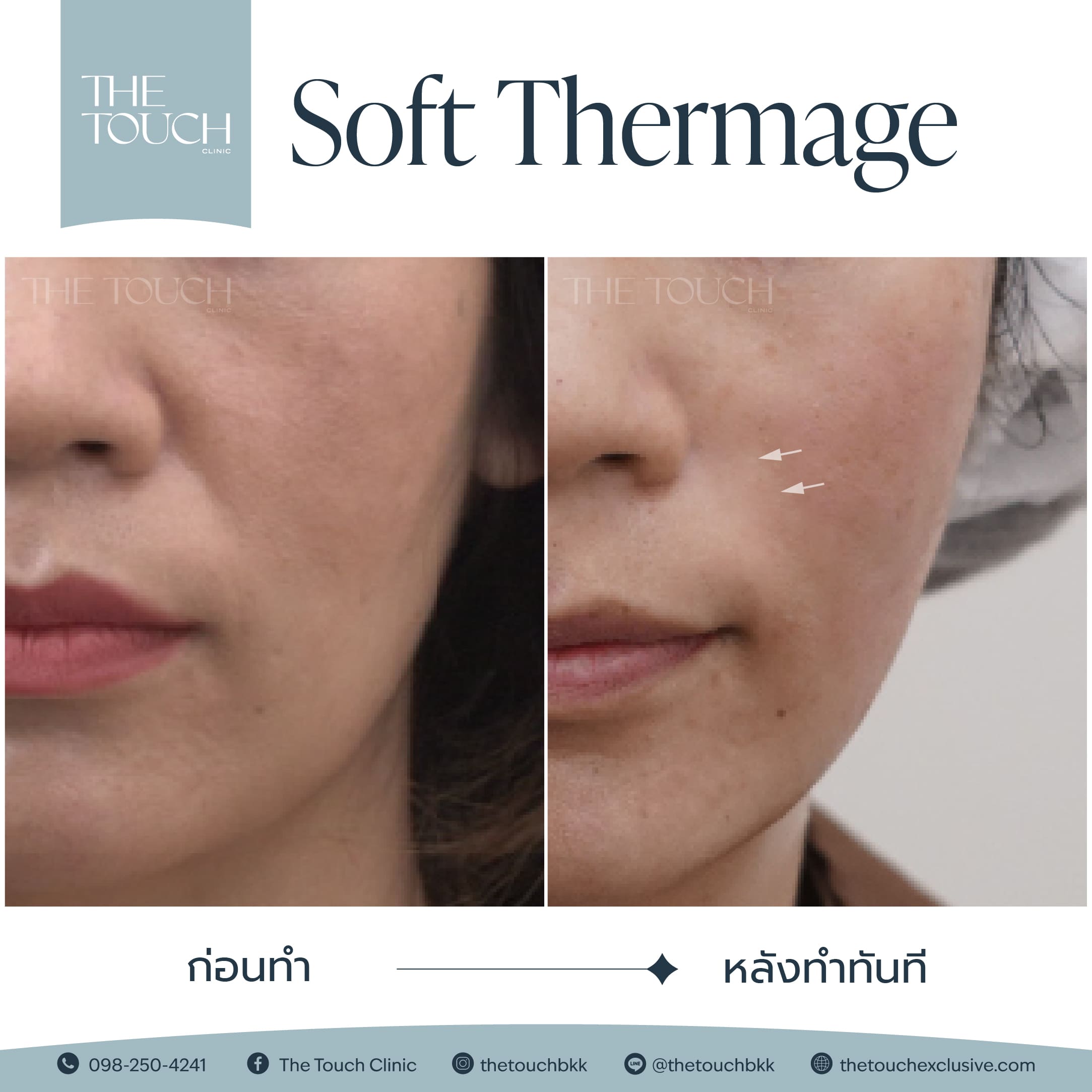 review-soft-thermage
