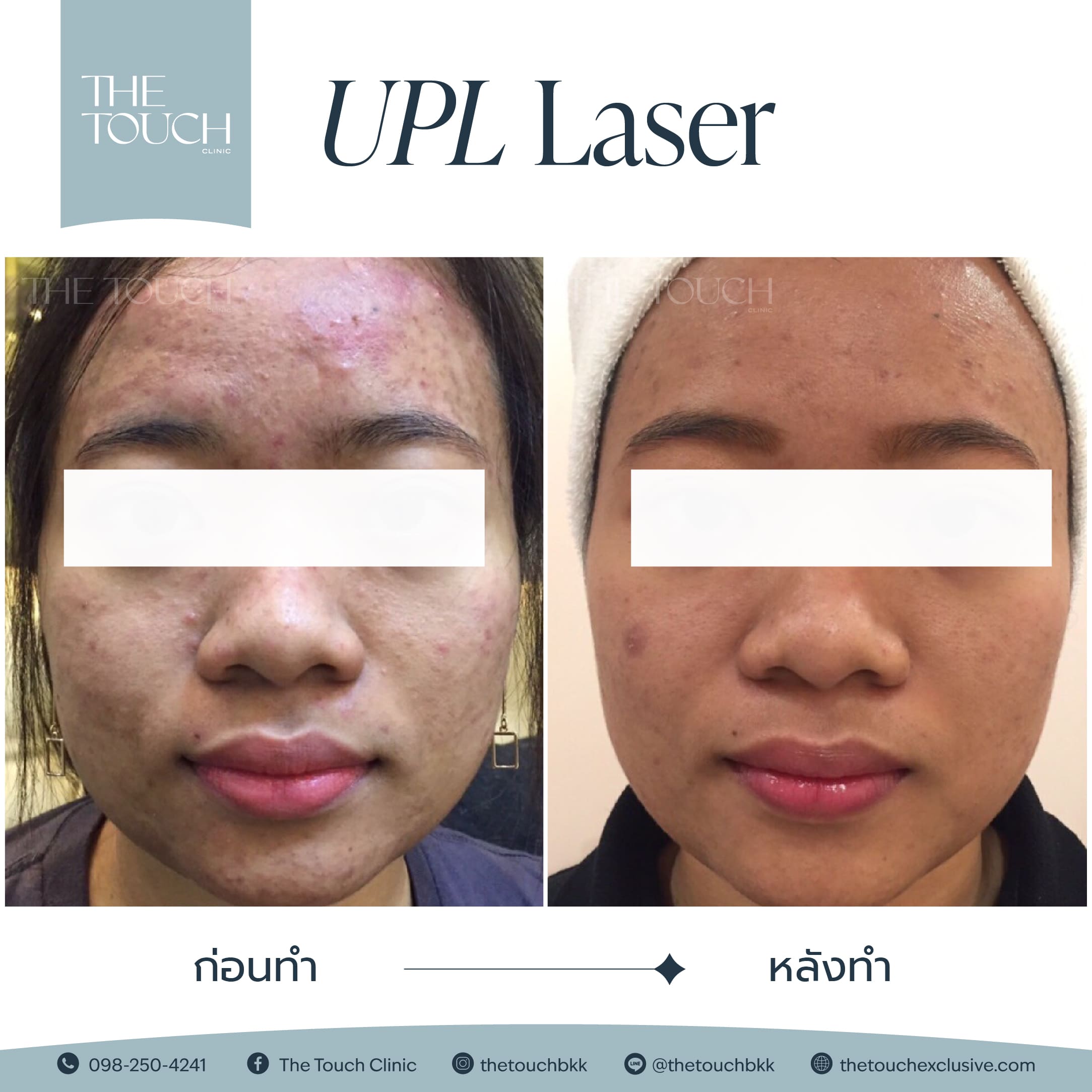 review-upl-ultimate-intensive-pulse-light