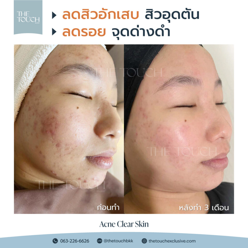 review-acne-clear-skin