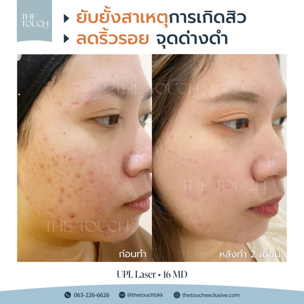 review-upl-ultimate-intensive-pulse-light