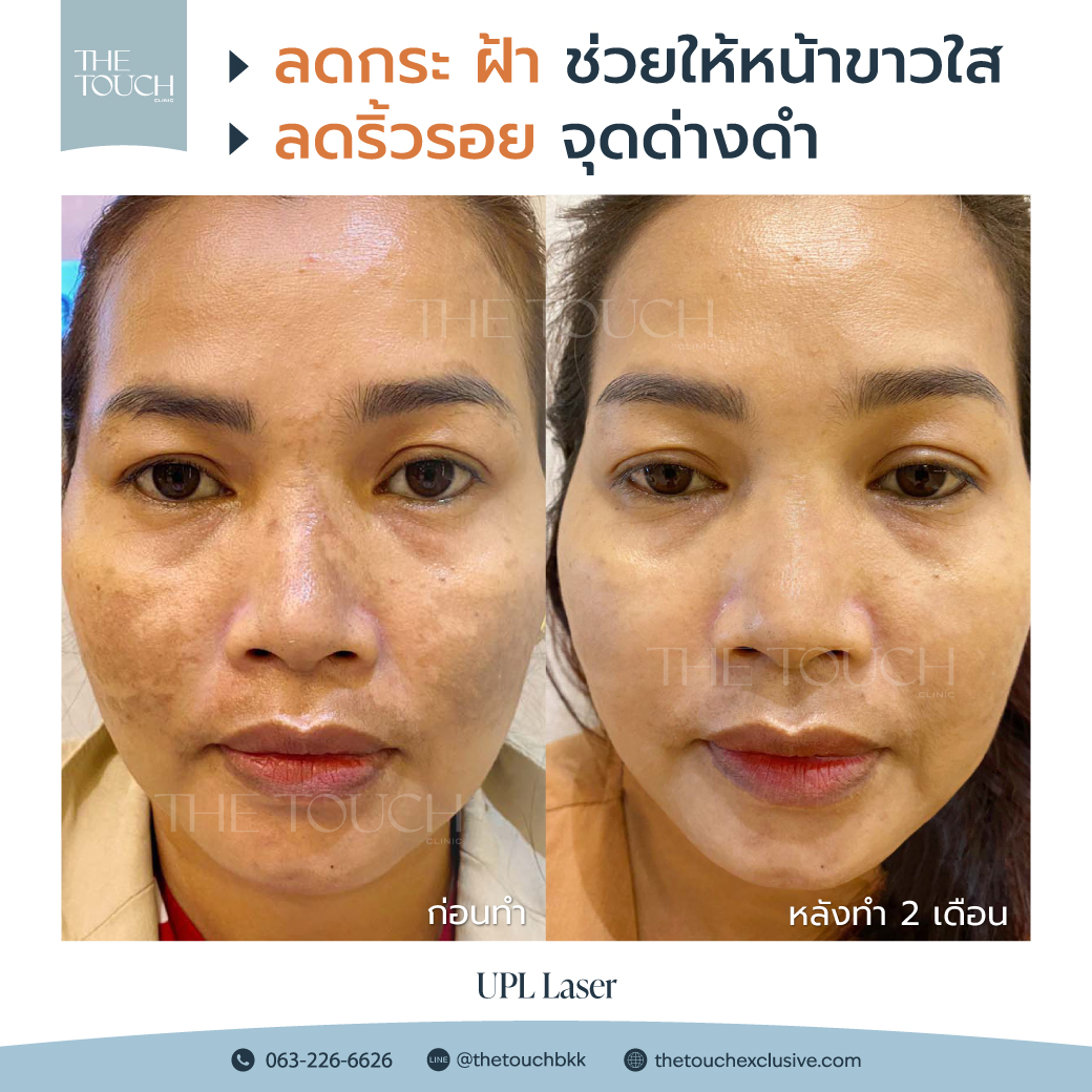 review-upl-ultimate-intensive-pulse-light