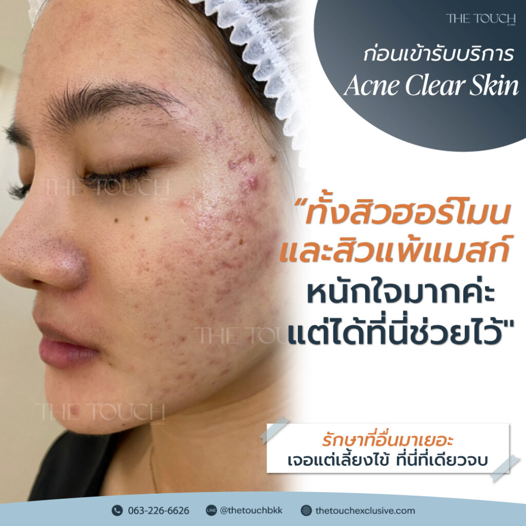 review-acne-clear-skin