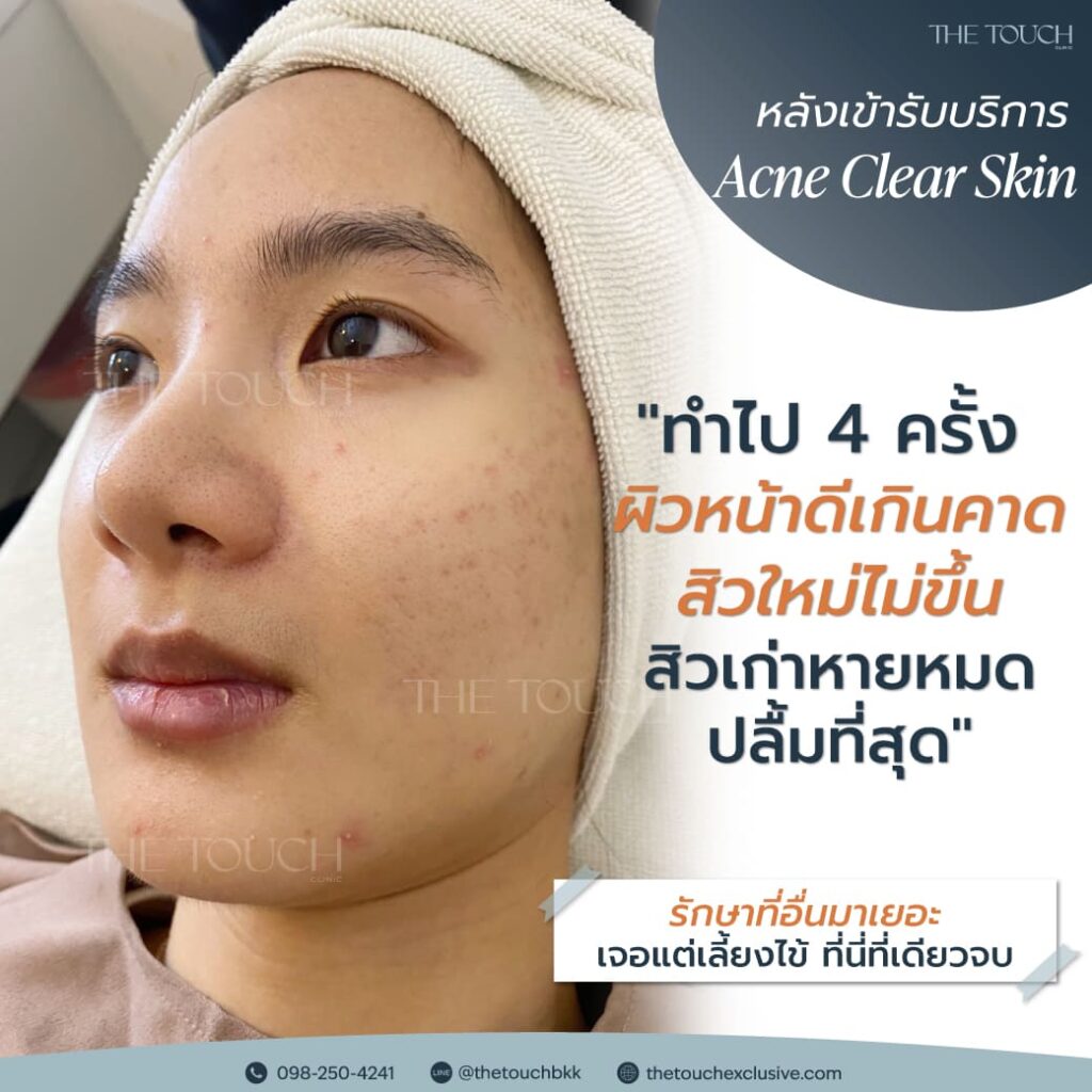 review-acne-clear-skin