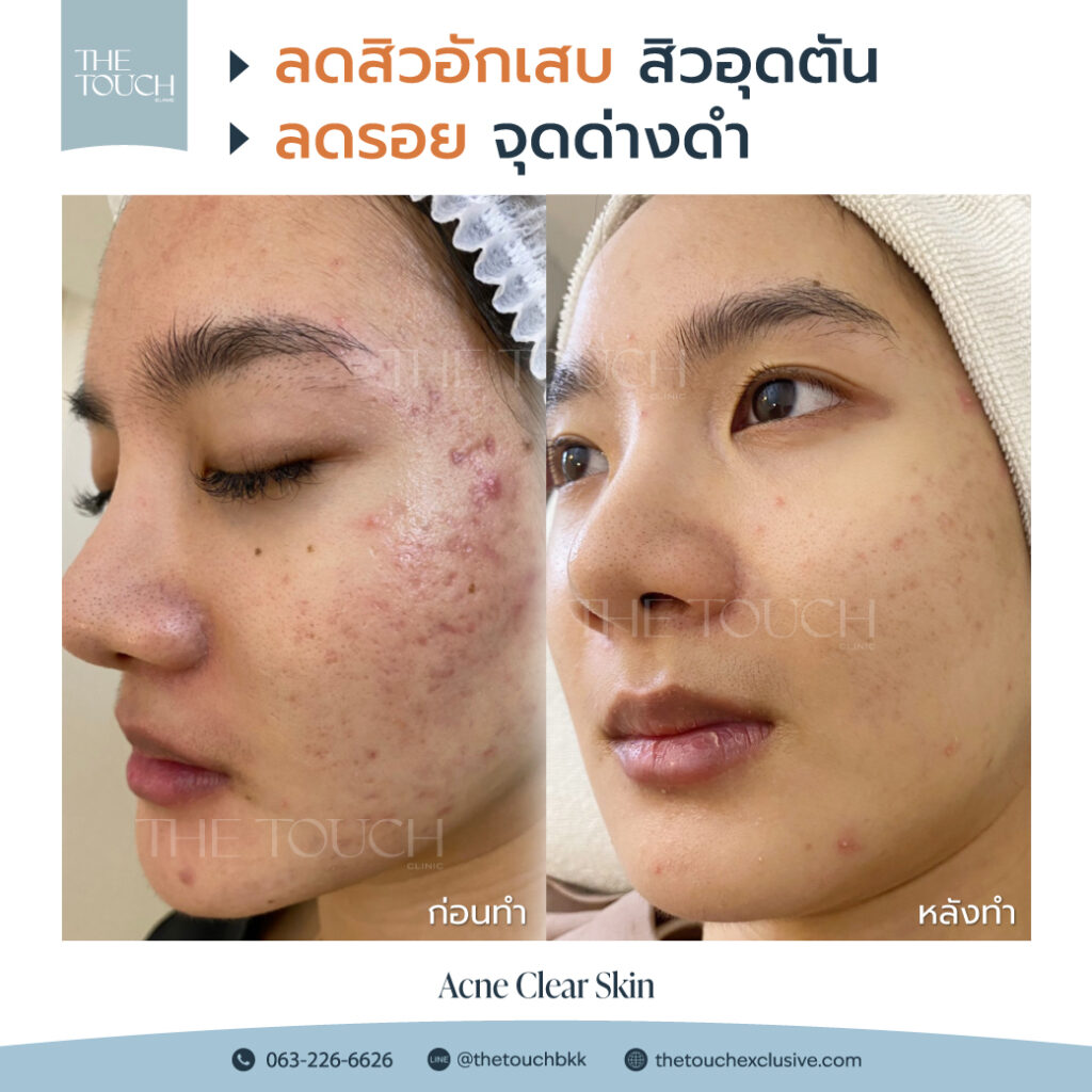 review-acne-clear-skin