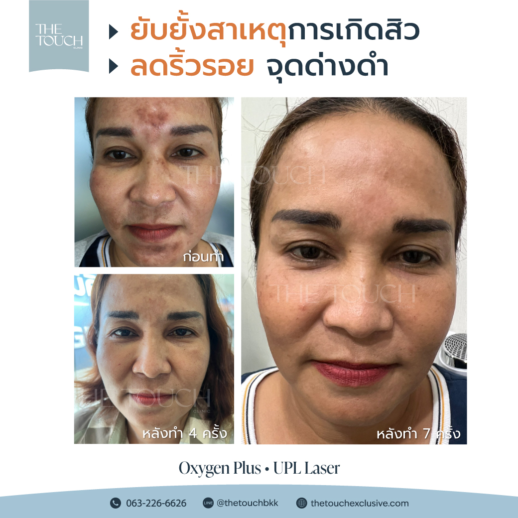review-upl-ultimate-intensive-pulse-light