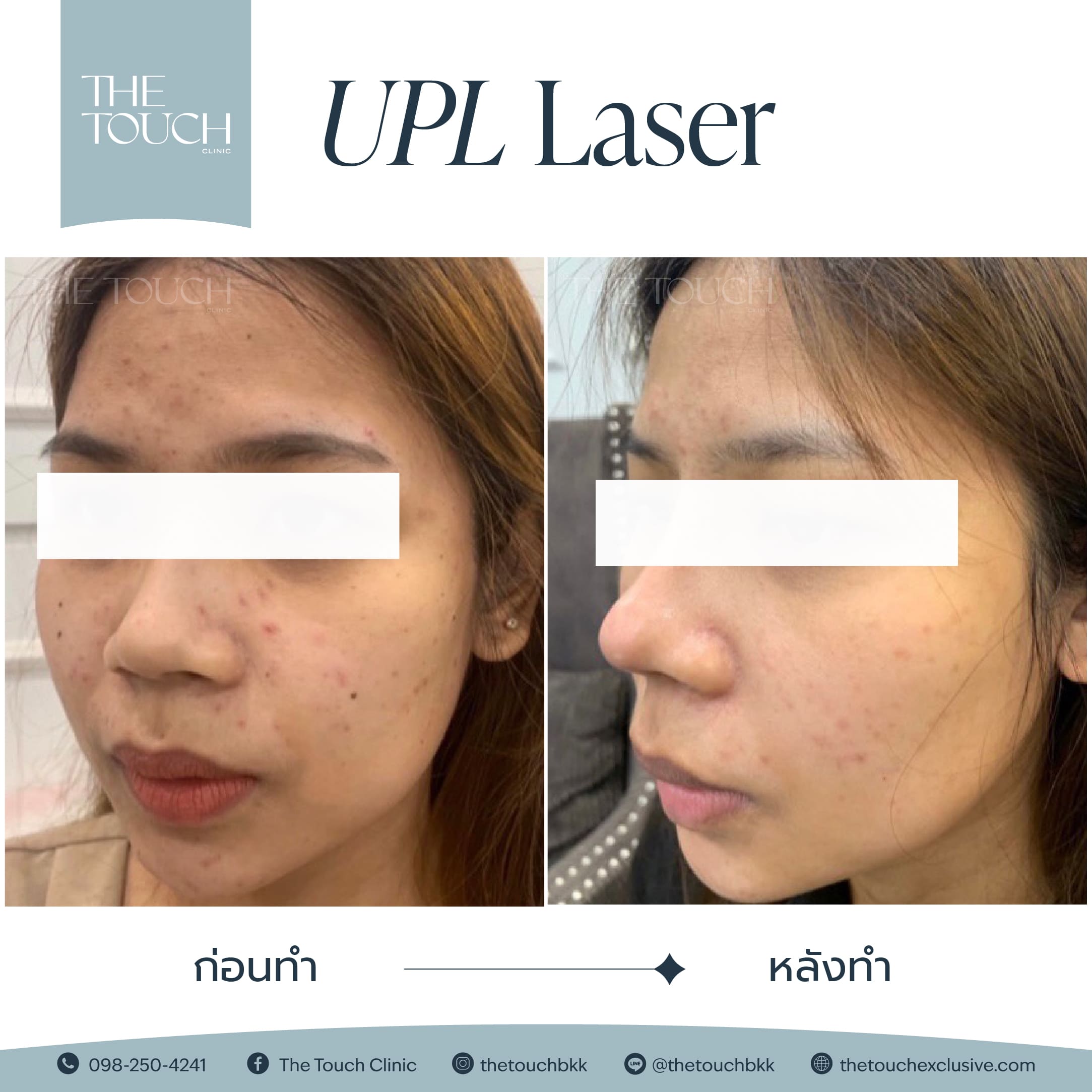 review-upl-ultimate-intensive-pulse-light