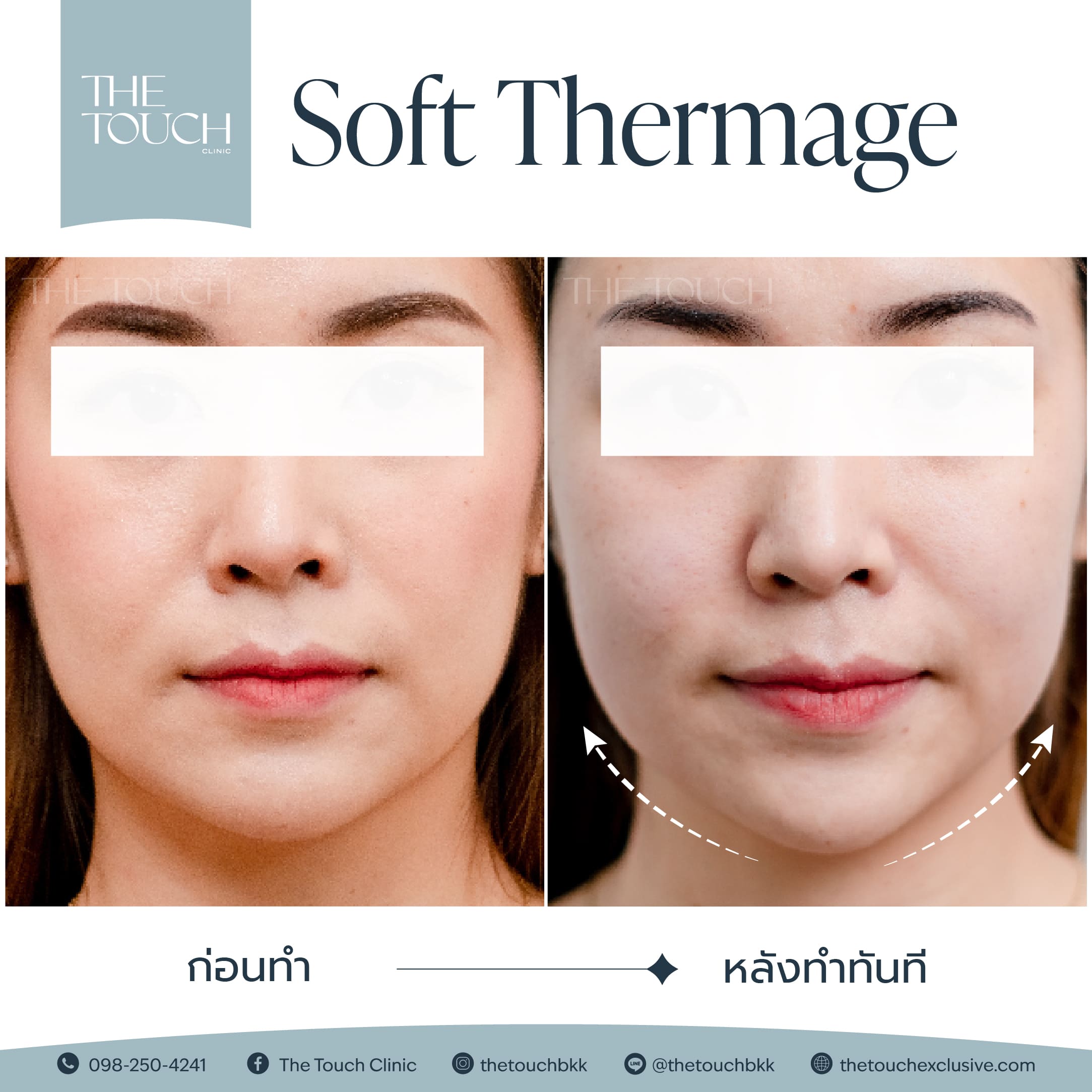 review-soft-thermage