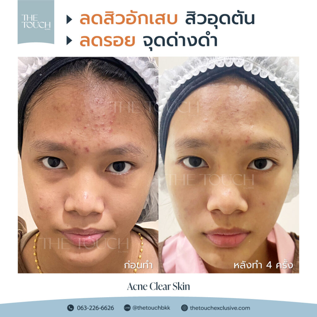 review-acne-clear-skin