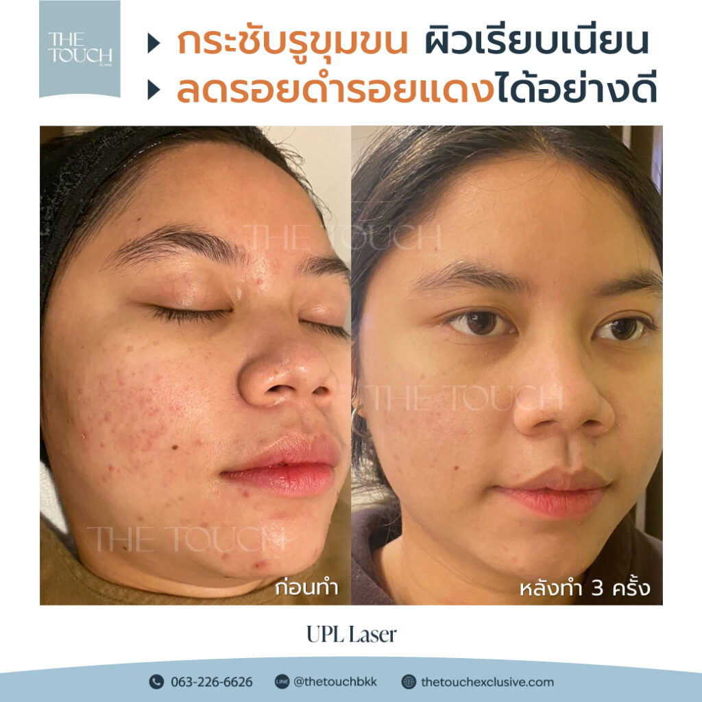 review-upl-ultimate-intensive-pulse-light