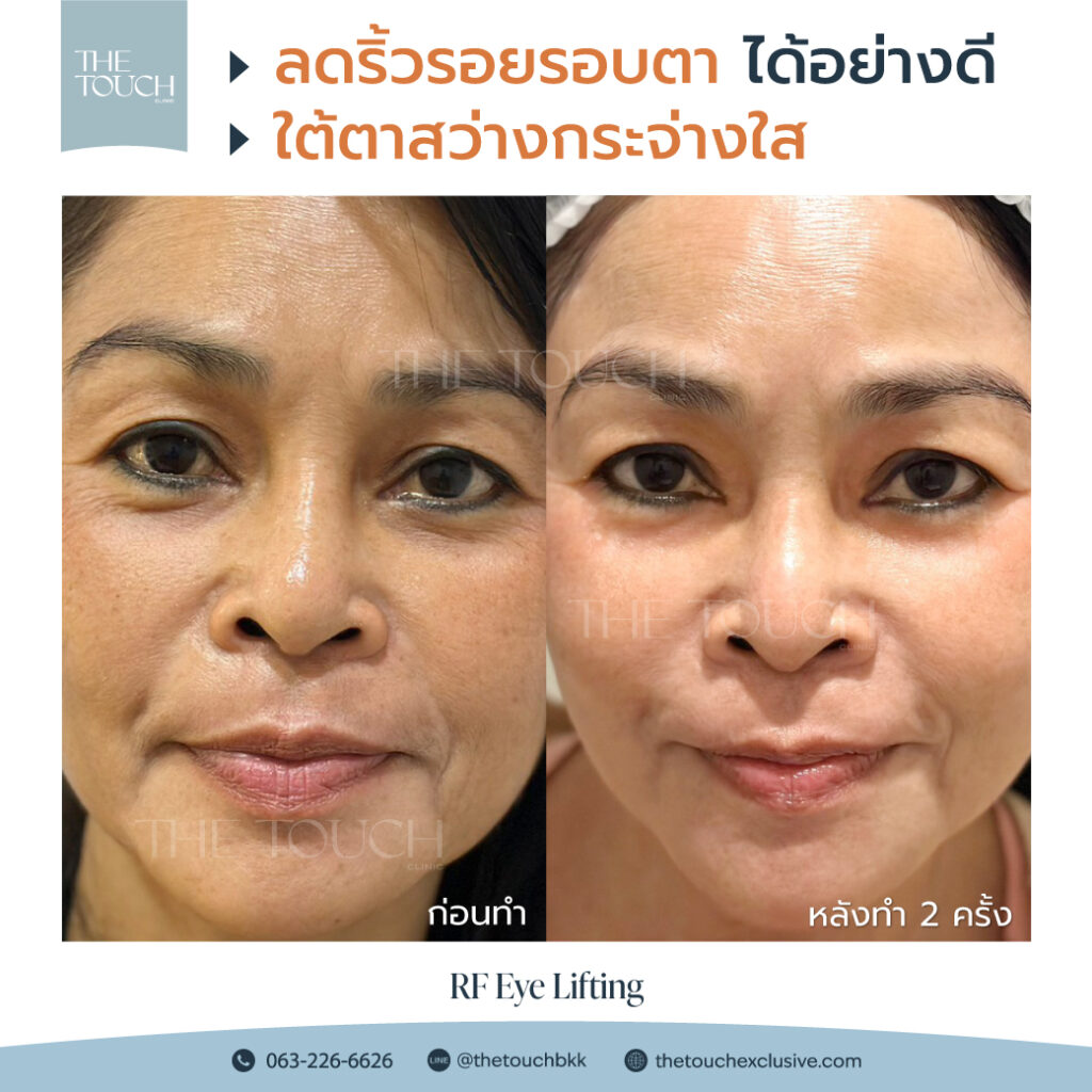 review-rf-eye-lifting