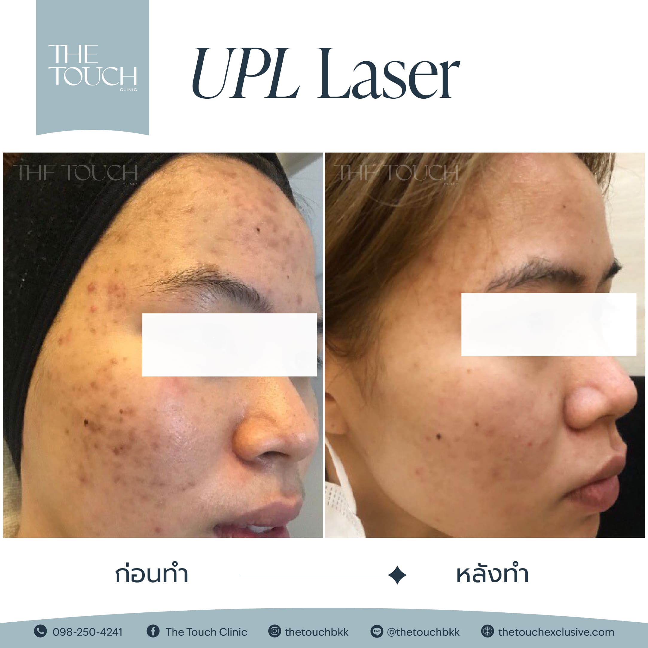 review-upl-ultimate-intensive-pulse-light