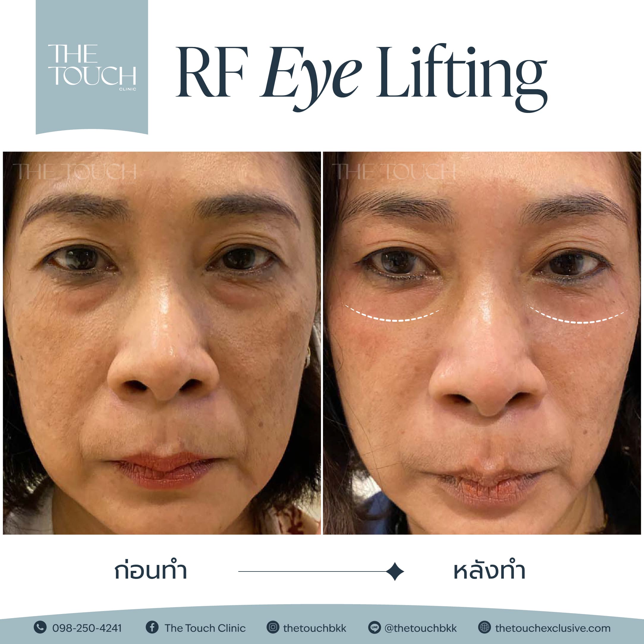 review-rf-eye-lifting