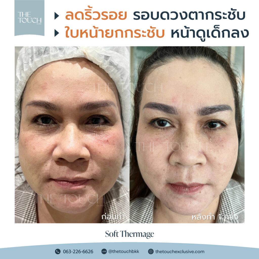 review-soft-thermage