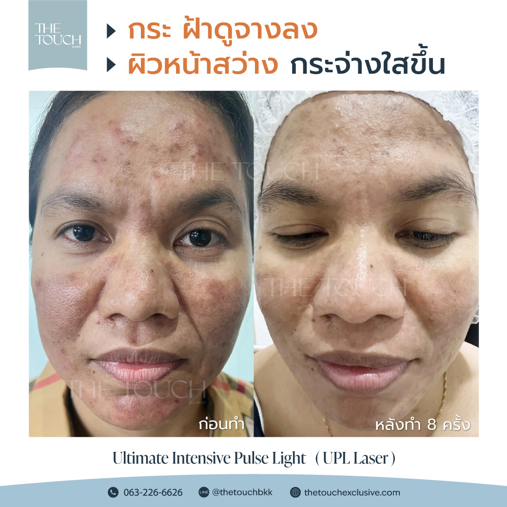 review-upl-ultimate-intensive-pulse-light