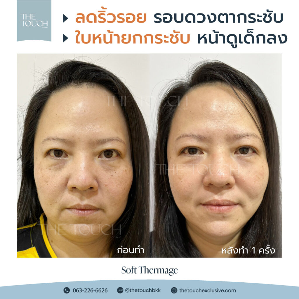 review-soft-thermage